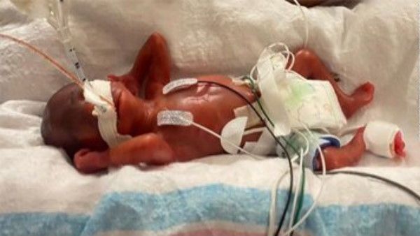 ये है दुनिया का सबसे हल्का नवजात, जन्म के समय आधा किलो से भी कम था वजन, अब वर्ल्ड रिकॉर्ड्स में दर्ज नाम
