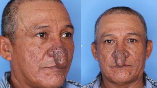 पेनिस जैसी हो गई इस शख्स की नाक, हमेशा उड़ता था मजाक, शर्मिंदगी से बचने के लिए उठाया ये कदम