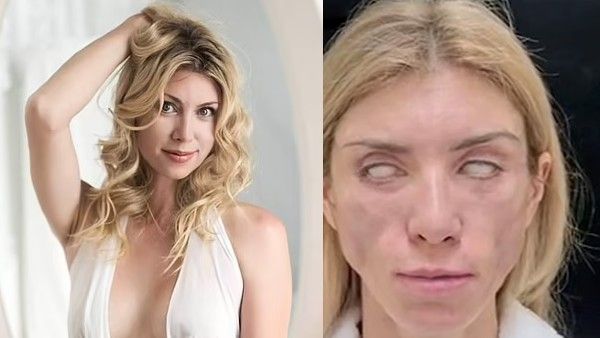 बढ़ती उम्र को मात देने के लिए ब्यूटी क्वीन ने करवाया ऑपरेशन, अब बंद नहीं होती आंखें, चेहरे का हुआ ये हाल