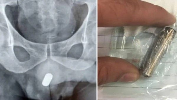 49 साल के शख्स का पागलपन, प्राइवेट पार्ट में डाली AA बैटरी, डॉक्टरों का उठाना पड़ा ये कदम