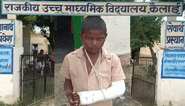 जालौर के बाद दौसा में लात मारकर तोड़ा दलित छात्र का हाथ, शिक्षक बोला-'ये मेरे खिलाफ साजिश है'