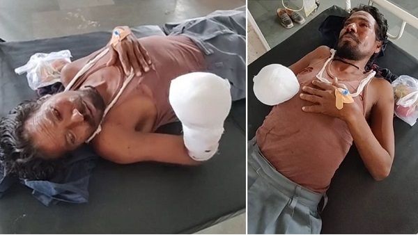 MP: नदी में डायनामाइट डालकर मछली पकड़ता था, हाथ में फट गई रॉड, हाथ का पंजा उड़ गया