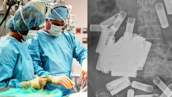 66 साल की महिला ने निगल लीं 55 बैटरियां, पेट के अंदर हुए 'चमत्कार' को देख डॉक्टर भी हैरान