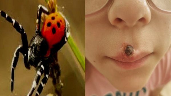 'मकड़ी' के काटने से स्टूडेंट हो गया 'लकवा'! बेडरूम में जाते ही कांप जाती है लड़की