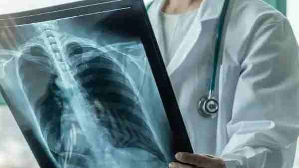 आंध्र प्रदेश ने टीबी के उपचार में 90 प्रतिशत सफलता हासिल की