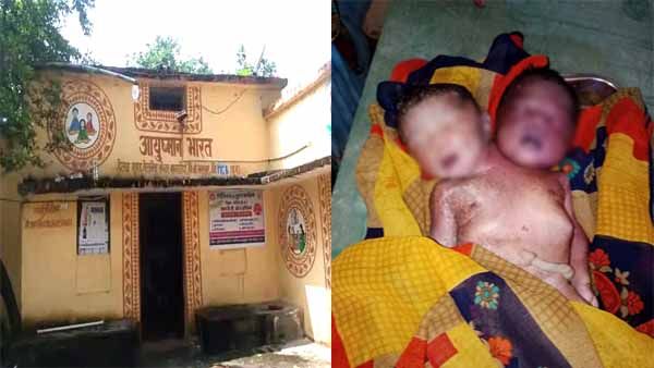 Chhattisgarh में दो सिर वाली बच्ची का जन्म, बना कौतूहल का विषय, डॉक्टरों ने बताया कारण