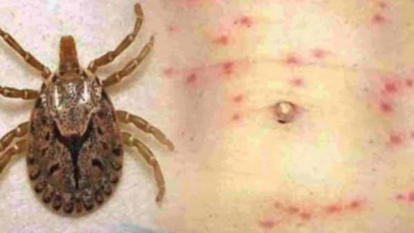 Scrub Typhus: सतना में स्क्रब टाइफस का प्रकोप, अब तक 37 मरीजों की पुष्टी
