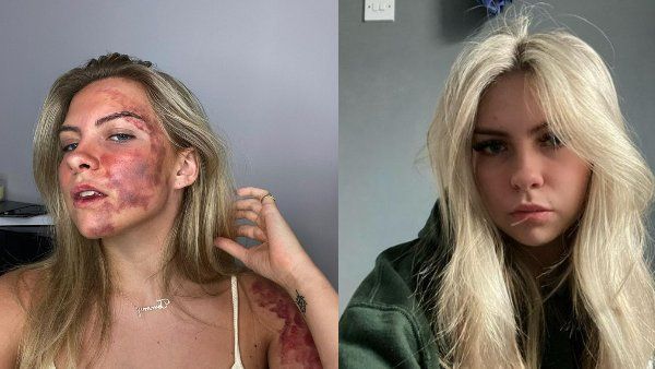 19 साल की लड़की को लगा विचित्र रोग, चेहरे और शरीर पर अजीब धब्बे,7 साल से ढूंढ रही इलाज!