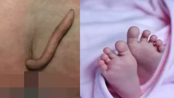 6 सेमी लंबी पूंछ के साथ पैदा हुई बच्ची, हैरान डॉक्टरों ने सर्जरी कर अलग किया हिस्सा
