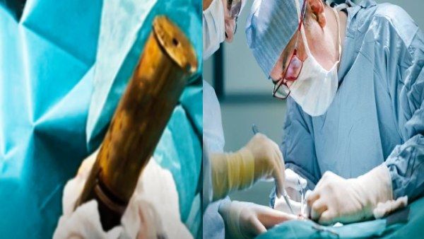 WWI Artillery Shell: शख्स के शरीर में घुसा 'बम का गोला', सहमे डॉक्टर, अस्पताल में मचा हड़कंप