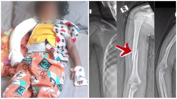 पैरोट की स्पेलिंग याद न होने पर बच्ची पर बिफरा ट्यूशन टीचर, हाथ मरोड़ने पर हुआ फैक्चर