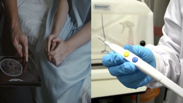 Intelligent Knife: कैंसर का पता लगाएगा 'बुद्धिमान चाकू', सेकंड भर में देगा Womb Cancer का रिजल्ट