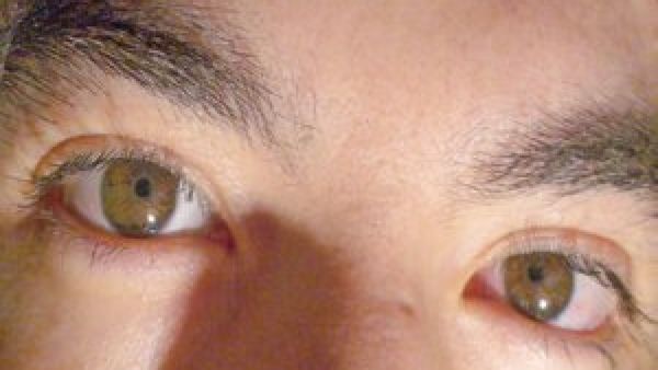 भारतीय आई ड्रॉप से गई अमेरिका के लोगों की आखों की रोशनी, ड्रग कंट्रोलर ने रुकवाया प्रोडक्शन