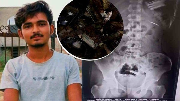 Yashpal Singh: राजस्‍थान का वो अकाउंटेंट जो निगल गया 56 ब्‍लेड, फिर करने लगा खून की उल्टियां