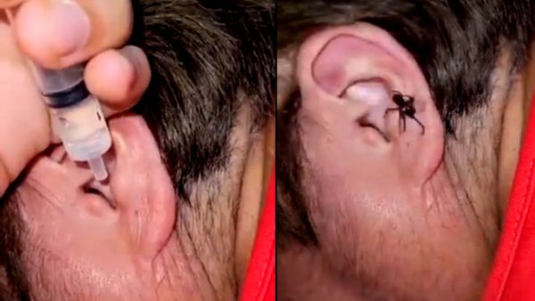 अपने रिस्क पर ही देखें ये Video! शख्स के कान के अंदर से निकली जिंदा मकड़ी