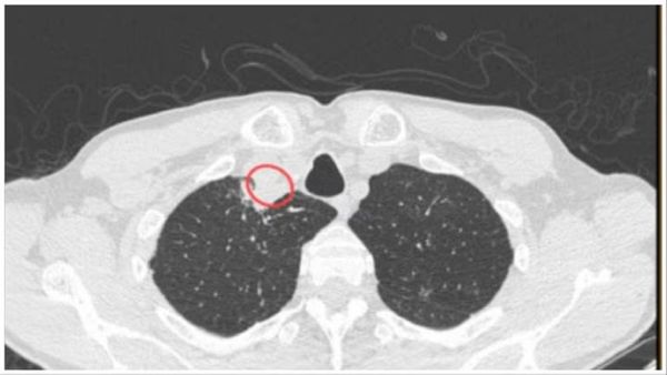 Plant Fungus: क्या है किलर प्लांट फंगस? जिसने फैला दिया है खौफ, भारत में दुनिया का पहला मामला