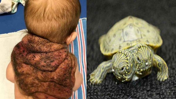 कुदरत का करिश्मा: कछुए जैसी त्वचा के साथ पैदा हुआ 'स्पेशल बच्चा', देखकर हैरान रह गए डॉक्टर
