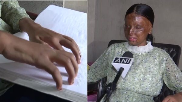 चपरासी की बेटी ने 10वीं में किया टॉप, रुला देगी 15 साल की एसिड अटैक सर्वाइवर की कहानी