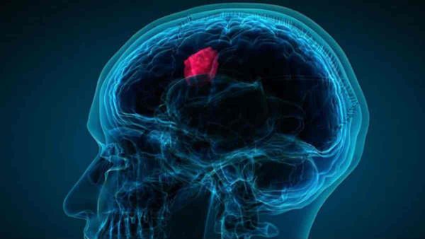 Brain Tumour Day: सिरदर्द को न करें नजरअंदाज, तनाव है ब्रेन ट्यूमर होने की सबसे बड़ी वजह