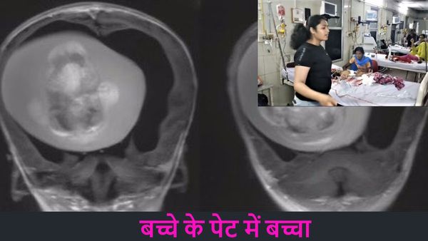 Fetus in fetu: आश्चर्यजनक! 7 माह के बच्चे के पेट में पल रहा था दूसरा बच्चा, करना पड़ा ऑपरेशन