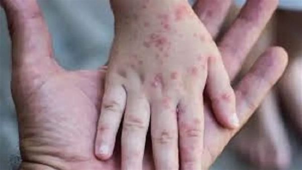 Monkeypox: क्या भारत में भी मंकीपॉक्स से महामारी का खतरा है?