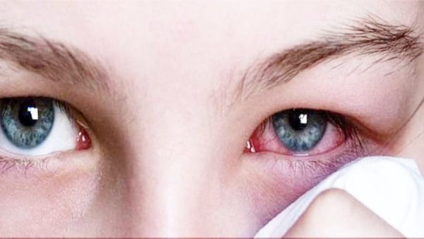 Satna News: सतना में Eye Flu का प्रकोप, अस्पतालों में तेजी से बढ़ रहे मरीज, एनएचएम ने जारी की एडवाइजरी