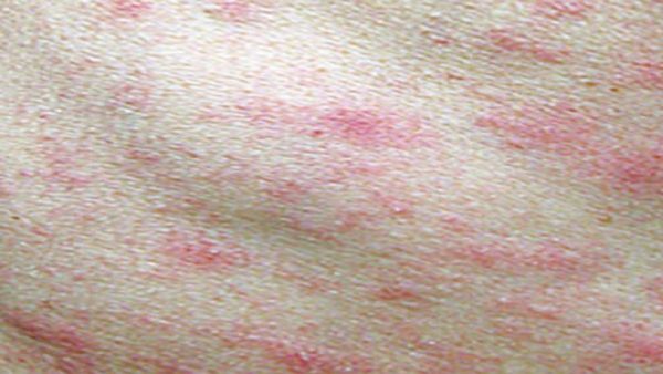 'ओडिशा में बच्चों में सबसे अधिक बढ़ रहा स्क्रब टाइफस का संक्रमण', ICMR की स्टडी में दावा