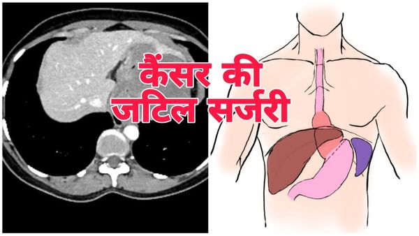 AIIMS Bhopal: आहार नली के निचले हिस्से के ट्यूमर की जटिल सर्जरी से 34 वर्षीय महिला को मिला नया जीवन