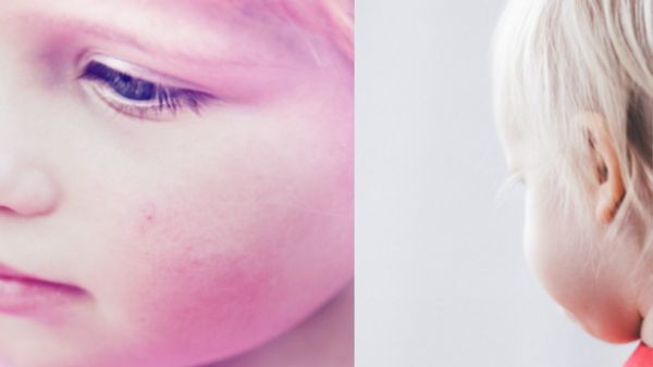 देश में तेजी से फैल रही ये खतरनाक बीमारी, हाथ लगाते ही गुब्बारे सा फूल जाता है गाल, आखिर क्या है 'गलसुआ'?