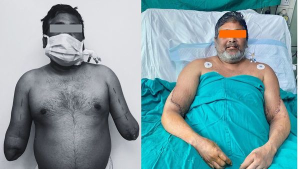 गंगाराम अस्पताल में चमत्कार: ट्रेन हादसे में शख्स ने गंवा दिए दोनों हाथ, डॉक्टरों ने सर्जरी कर दिया नया जीवन