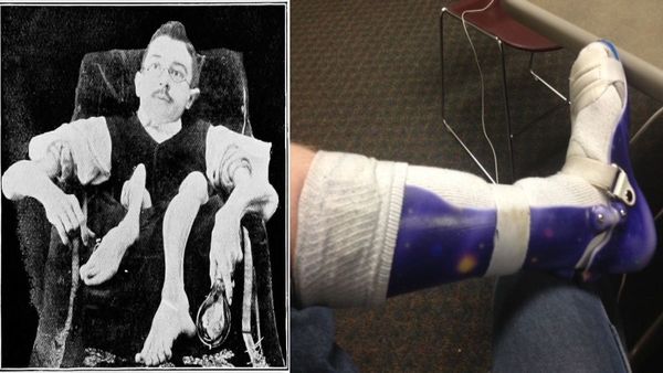 Muscular Dystrophy: क्या है मस्कुलर डिस्ट्रोफी, जिसके इलाज का खर्च 17 करोड़ रुपए, क्राउड फंडिंग ही एकमात्र आशा