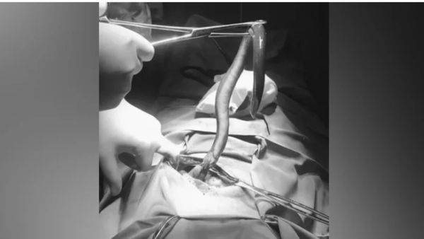 पेट दर्द से परेशान था शख्स, डॉक्टरों ने ऑपरेशन किया तो बाहर निकली जिंदा मछली, कैसे पहुंची अंदर?