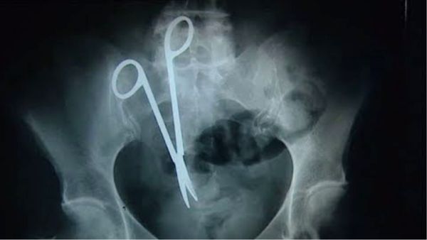 MP में सरकारी डॉक्टरों की लापरवाही! महिला के पेट में छोड़ दी थी कैंची, 10 साल बाद सर्जरी कर निकाली गई