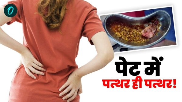 पथरी का दुर्लभ मामला! डॉक्टरों ने महिला के गॉलब्लेडर से निकाली 1235 पथरी, आयुष्मान कार्ड से हुआ मुफ्त इलाज