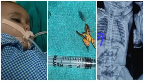 MP News: जबलपुर में डॉक्टरों ने रचा चमत्कार, फेफड़े से निकाला कीड़ा, सांस की नली से निकाला चिकन का टुकड़ा