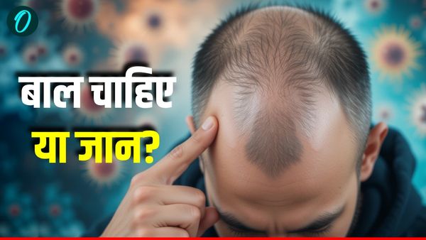 Hair Transplant: बाल चाहिए या जान? कानपुर में हेयर ट्रांसप्लांट ने ली दो जिंदगियां, एक ही डॉक्टर कटघरे में