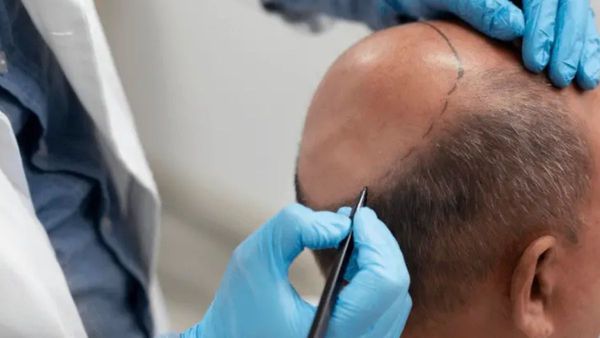 बाल वापस लाने की चाह में गई जान! कानपुर में हेयर ट्रांसप्लांट बना जानलेवा, इन्फेक्शन से हुई इंजिनियर की मौत