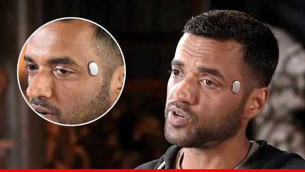 'अमीरों का फैंसी खिलौना', Deepinder Goyal के सिर पर चिपके Temple डिवाइस पर क्या बोले डॉक्टर? बताई असली सच्चाई