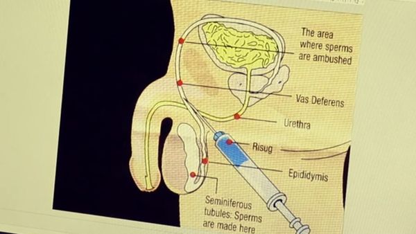 पिता बनने से रोकने वाला इंजेक्शन, लेकिन क्या आगे आएंगे मर्द