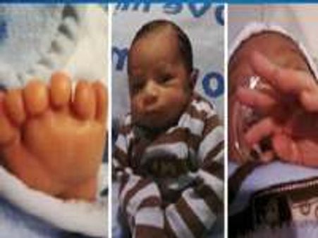 Boy born with 12 toes & 12 fingers