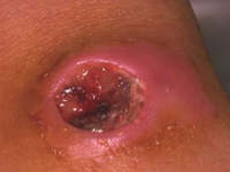 Anthrax outbreak in remote areas of AP