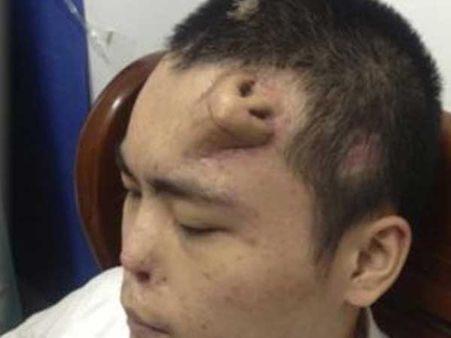 China: Man gets a new nose on his forehead