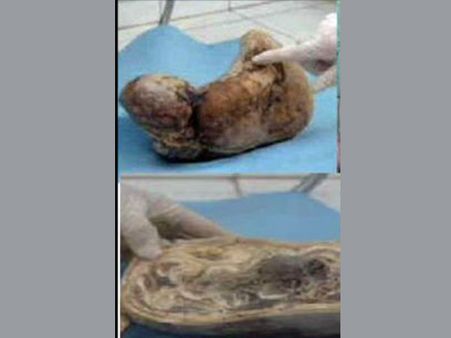 Bizarre: 44-year-old 'dead foetus' found inside Brazilian woman