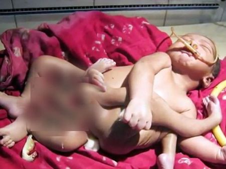 WB: Baby boy born with 4 arms, 4 legs; dubbed as “Hindu God” by parents