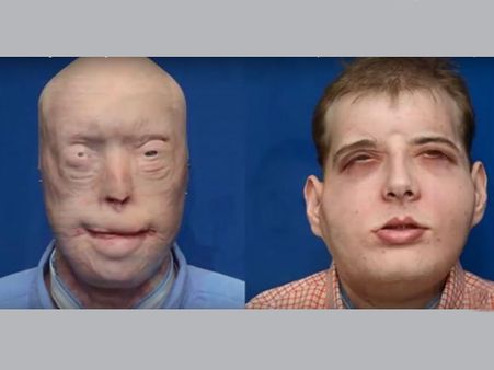 US firefighter gets world's most extensive face transplant