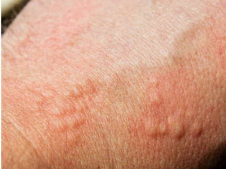 Food additive that may prevent skin cancer