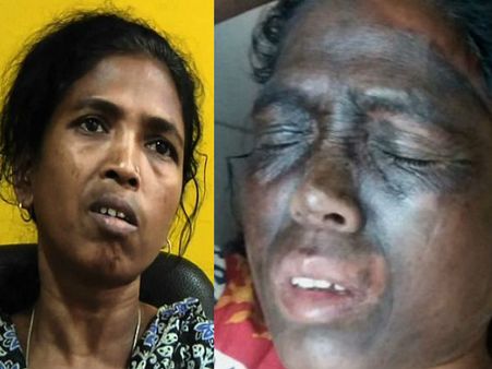 Unidentified men hurl acid like chemical on Soni Sori