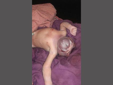 (Graphics) Baby girl born without skull dies in Jharkhand