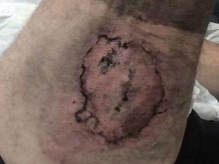 Woman's face burned after headphones explode mid-flight