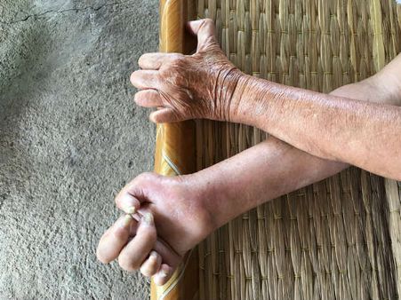 Odisha: Leprosy affected denied dignity, daughter, son carry body for funeral